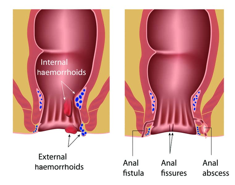 crohns