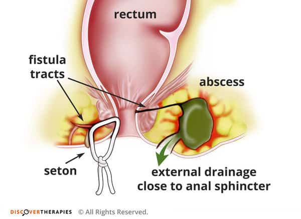 With perianal fistulas