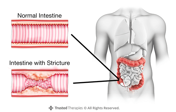 Crohns